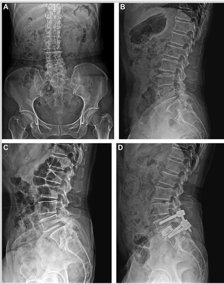 #NEUPrac Clinical and Radiological Outcomes of Full-Endoscopic Decompression for Lumbar Spinal Stenosis With Grade I Degenerative Spondylolisthesis: A Retrospective Study With a Minimum 1-Year Follow-up bit.ly/3T7jzHp by Choi et al Nanoori Gangnam Hospital @CNS_Update