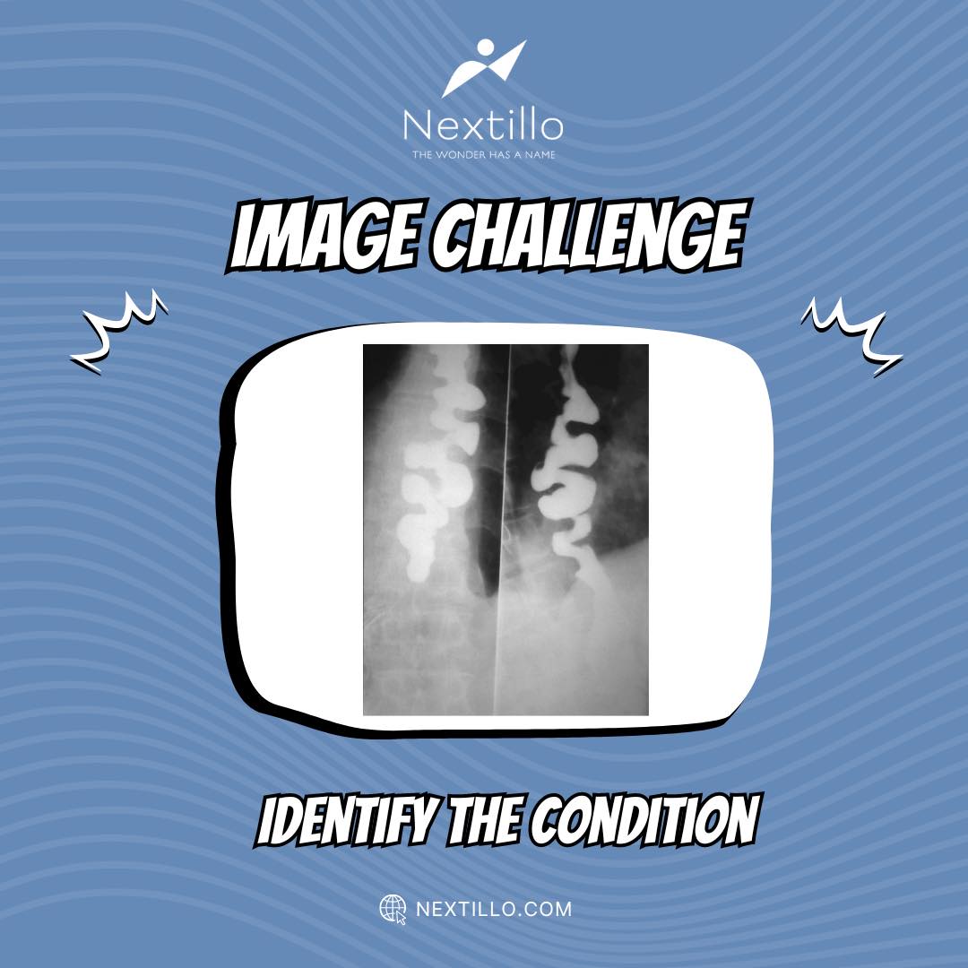 Here’s today’s #ImageChallenge! Can you identify the condition? 📷
#medicalmemes #fmge #fmge_mci_exam #medicalinformation #fmgequestions #fmgepreparation #medicalstudent #radiology #radiologysigns #radiologyquiz #mriscan #mriquestions #ctscan