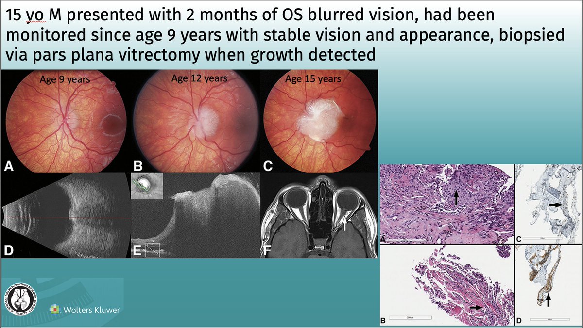 Optic Nerve Sheath Meningioma Presenting as a Slow-Growing Intraocular Mass: Journal of Neuro-Ophthalmology
Article: bit.ly/JNO_ONSM_intra…
 #brain #eye #vision #research #NeuroTwitter #NeuroOphth #EyeTwitter #MedTwitter @pmcancercentre @UHN @uoftmedicine