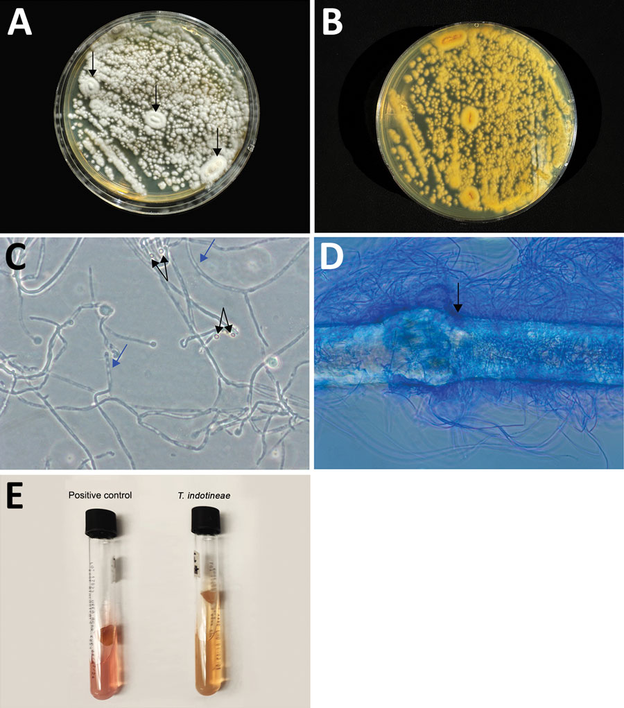 #Tinea genitalis was found in an immunocompetent woman. The infection was caused by #Trichophyton indotineae potentially acquired through sexual contact. Learn more in this April 2024 EID journal article: bit.ly/3wEu6C9 (Authors: Stephanie Spivack, et al.)
