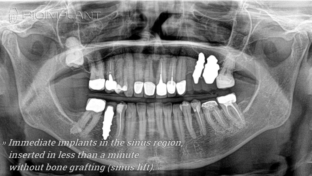 #Ceramic #Implant #toothimplants #teethaesthetic #dental #technology #future #solutions #tooth #BioImplant #immediate #industrie #cadcam #cadcamdentistry #DentalImplants #BioImplant