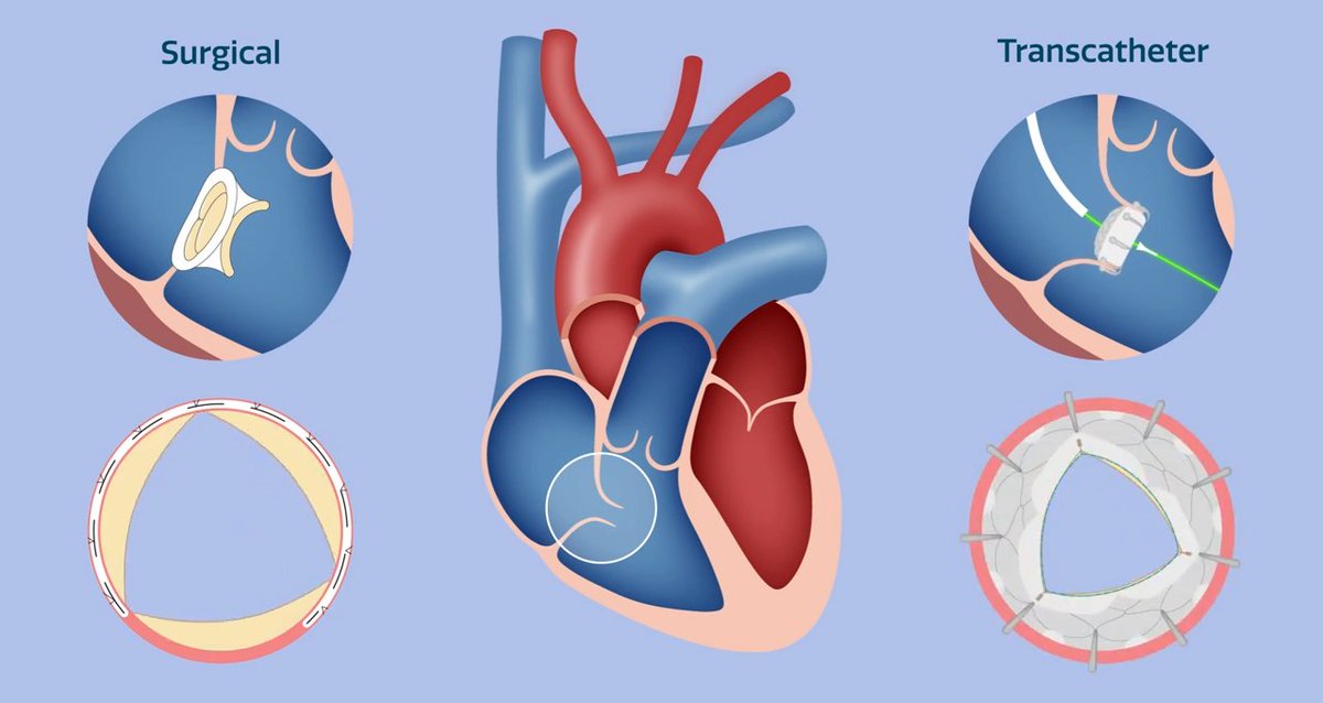 STS has launched a new risk calculator on isolated tricuspid valve repair and replacement, which leverages real-world data from the STS Adult Cardiac Surgery Database to guide decision-making between surgeons and patients. #CTSurgery Learn more: bit.ly/3vCA722