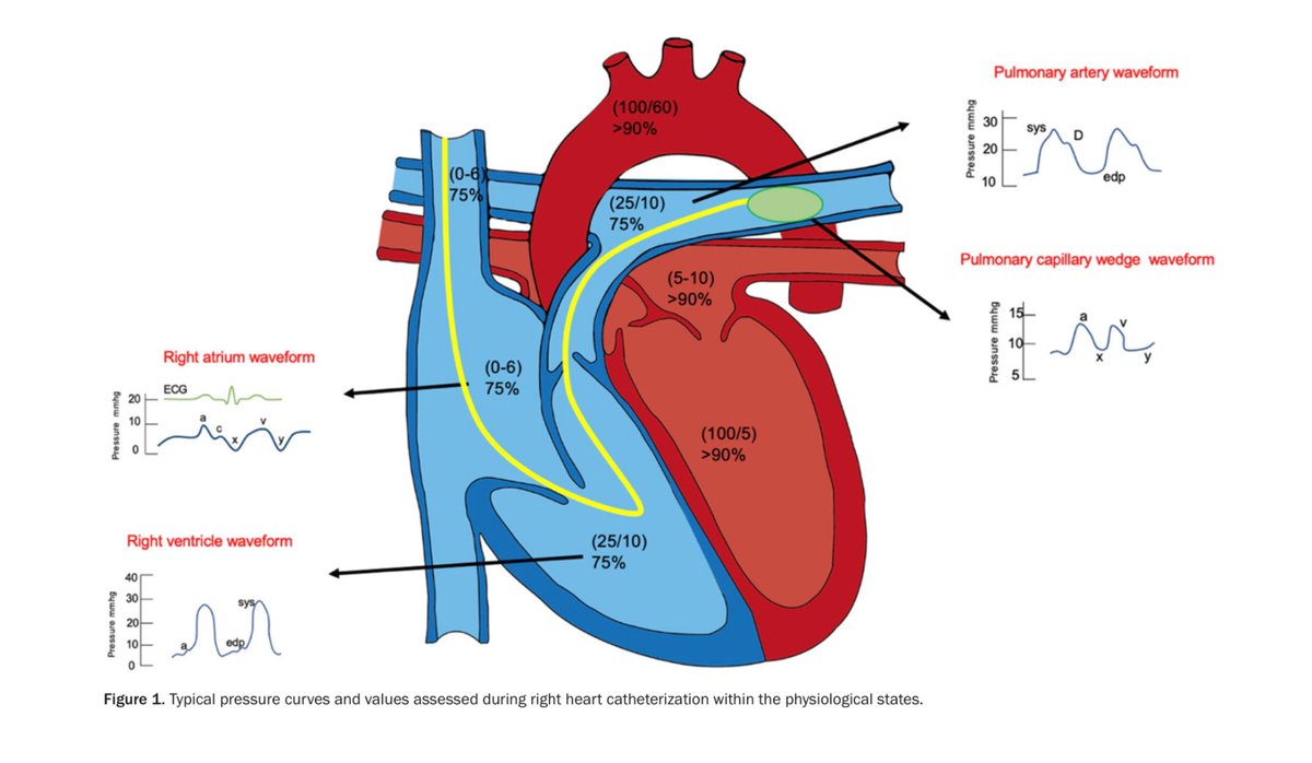Right heart catheterization in clinical practice: a review of basic physiology and important issues relevant to interpretation.
🔗 pubmed.ncbi.nlm.nih.gov/37469534/
#FOAMed #FOAMcc #hemodynamics