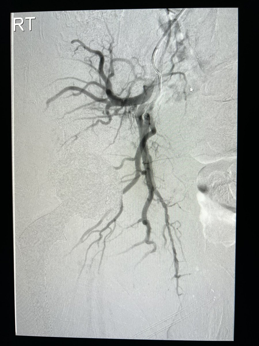 Springtime is upon us, time for some pruning. RCC met with unstable arthoplasty, embo+radiation performed to facilitate revision. #IO #Embo #VIRad #MSK #Ortho #MedEd #Oncology