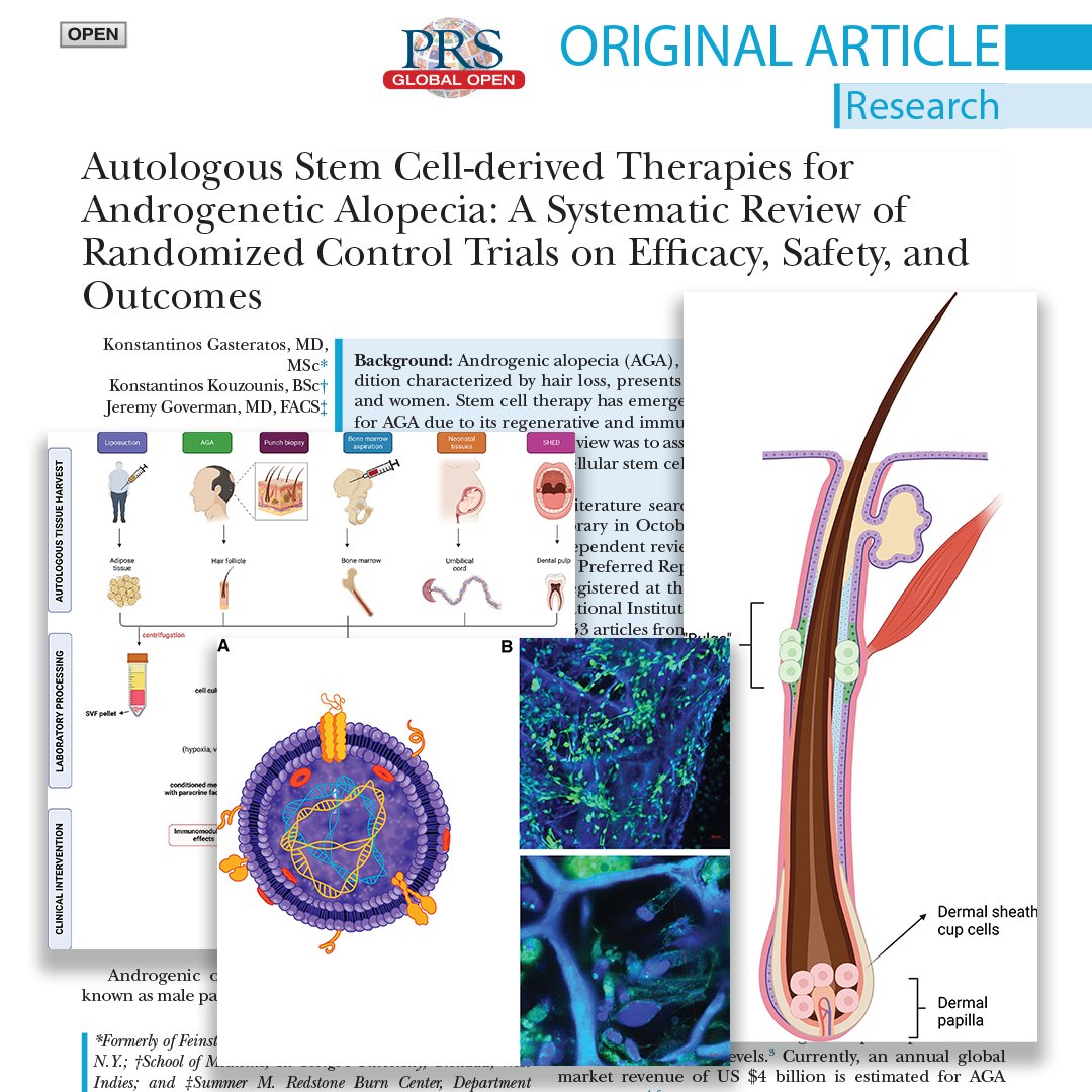 What is the efficacy and safety of autologous cellular and acellular stem cell–derived therapies for androgenic #alopecia? Read, 'Autologous #StemCell-derived Therapies for Androgenetic Alopecia,' to find out: bit.ly/StemCellAlopec…