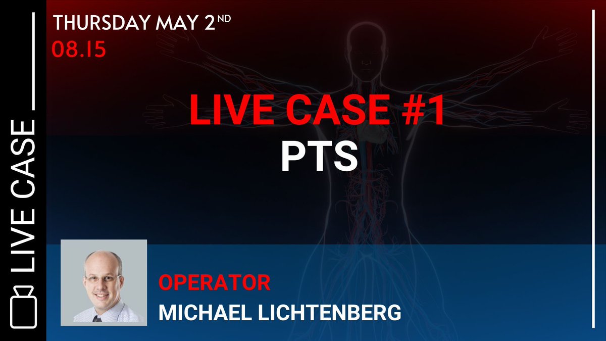 #MLCTOENDO2024 - Don’t miss the 1st live case on the post-thrombotic syndrom, performed from 🇩🇪 on May 2nd at 8.15.
Join us in 🇧🇪 &amp; watch this live case to enhance your skills in #endovenous treatment.

Still on time to save your seat ➡ swll.to/register-MLEND…
#endovascular #CTO