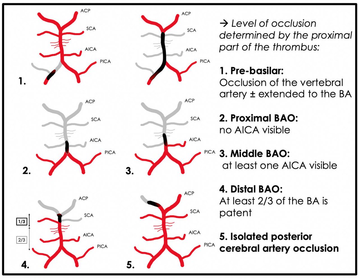 Is contact aspiration better than stent-retriever for basilar artery occlusion? @sarov, @RaoulPop25, @jildazz demonstrate that this may be so! Check out this new published article: bit.ly/3PHxrqM