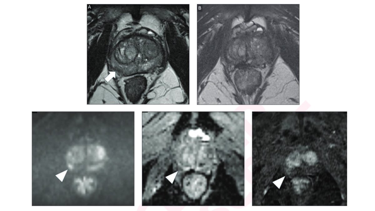 New <a href="/AJR_Radiology/">AJR</a> Accepted Manuscript:

"New Prostate MRI Scoring Systems (PI-QUAL, PRECISE, PI-RR, and PI-FAB): AJR Expert Panel Narrative Review"

By Drs Dias, <a href="/giga_fra/">Francesco Giganti</a>, &amp; team

ajronline.org/doi/10.2214/AJ…
