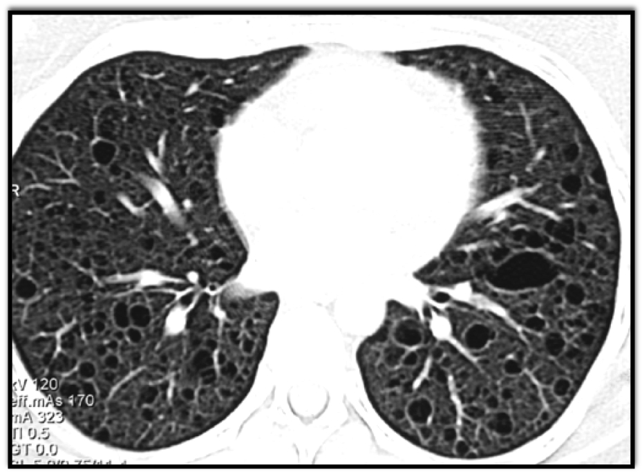 The most likely dx?

  A. lymphangiomatosis
  B. sarcoidosis
  C. cystic fibrosis
  D. interstitial fibrosis (IPF)

Poll below 👇

Answer here: ctisus.com/learning/quiz/…