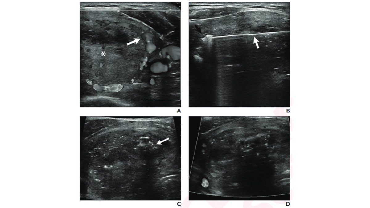 New @AJR_Radiology Accepted Manuscript: 'Thermal Ablation of Thyroid Nodules, From the AJR 'How We Do It' Special Series' By Drs @shamaryoungmd, @LWalkerMD, & @ir_huber ajronline.org/doi/10.2214/AJ…