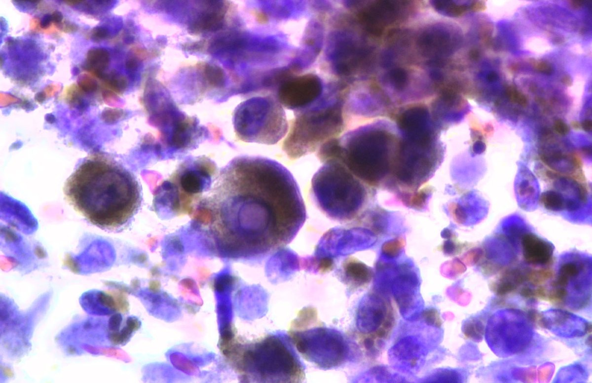 'Grossing in cytology' 🧐👀
FNA of mediastinal lymph node.
It may be good (anthracosis)....
Or not... : melanoma mets (bottom)
'Similar macroscopic appearance, but different at the 🔬🔬🔬 #CytoPath #LovingCytopathology