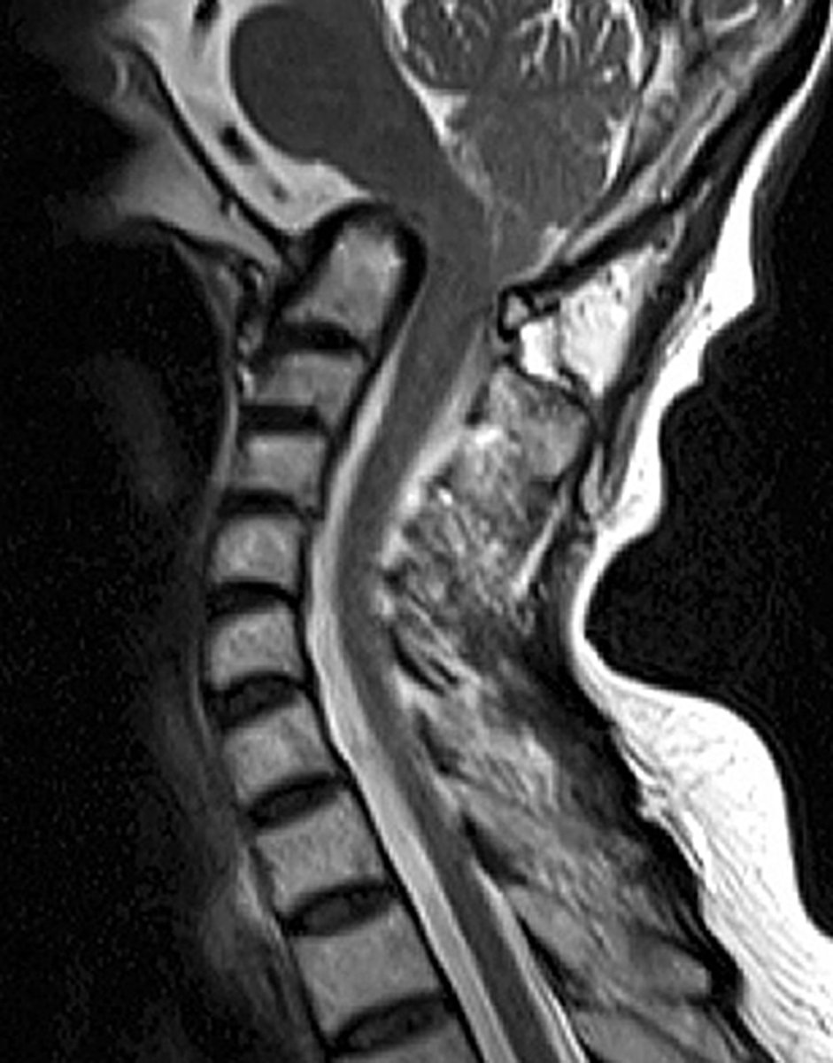 Radiographs and MR image of 65YO woman with rheumatoid arthritis, posterior headaches, hand/gait clumsiness, dizziness. Diagnosis?

1-Rheumatoid plaque
2-Atlantoaxial subluxation
3-Basilar invagination
4-Subaxial subluxation

Explore more: bit.ly/2IIlLV7  
#LearnwithAAOS