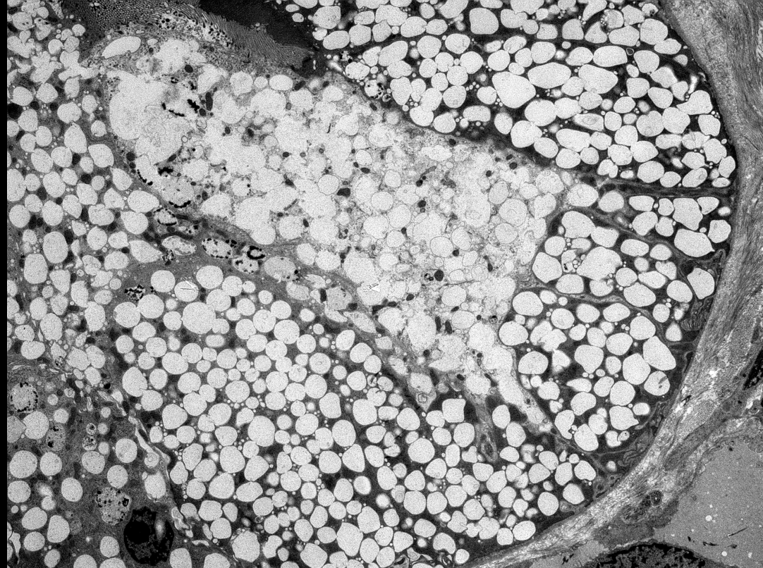 JZRenalPath's tweet photo. AKi in a pt with recent contrast administration and antibiotic use. Features of contrast nephropathy and allergic interstitial nephritis. #renalpath #pathtwitter https://t.co/v8qkPx5w4Q