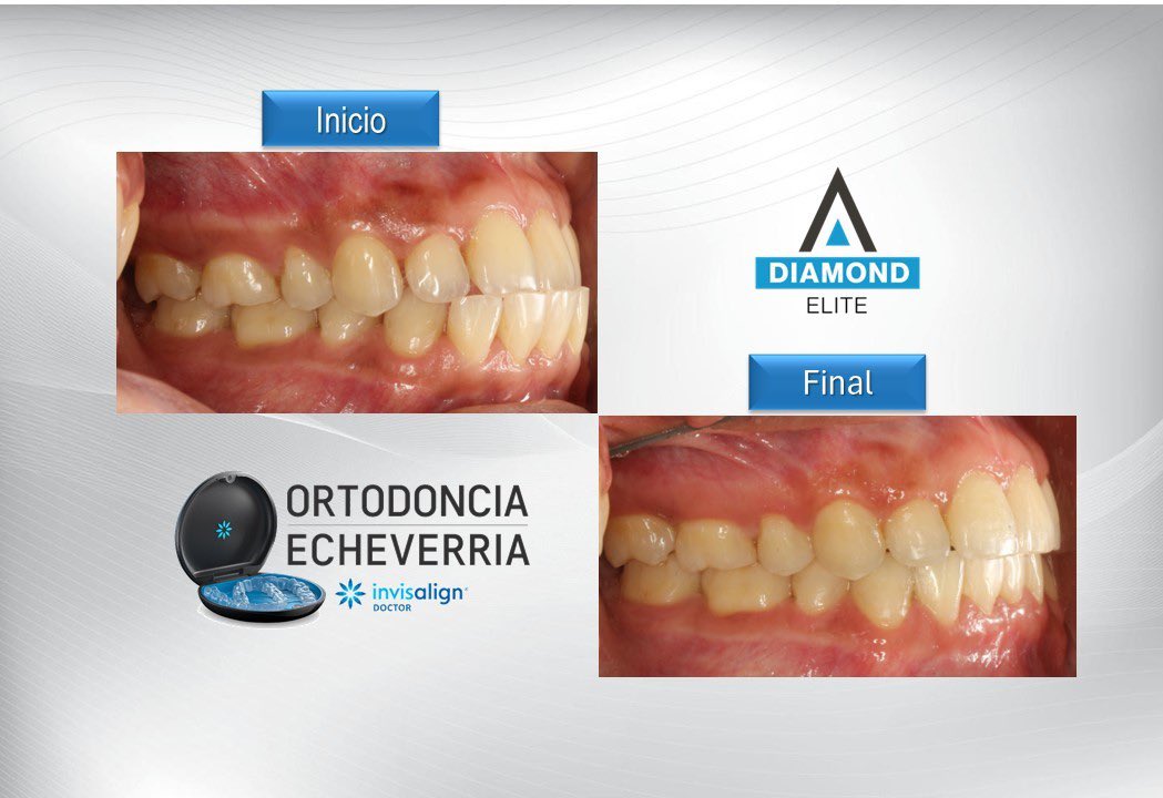 RaulEcheverriaQ's tweet photo. Corrección de mordida cruzada anterior en un paciente adulto en 10 meses de tratamiento con el Sistema Invisalign. 👌🏻👏🏻🤩🇸🇻
#invisalign #itero5d #ortodonciainvisible #diamondelite #invisalignfirst #invisalignweek #ortodonciaecheverria #elsalvador🇸🇻 https://t.co/TXxF1Oo5mc