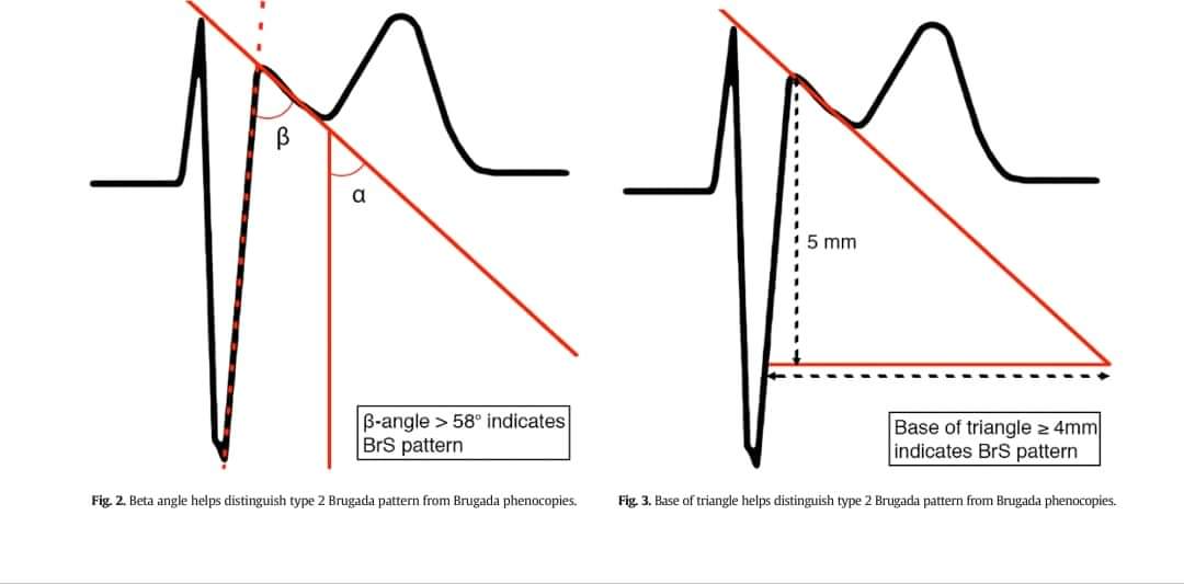 drahmedmohsen85's tweet photo. How to differentiate between incomplete Right bundle branch block(or other Brugada phenocopies)  and type 2 Brugada syndrome?
 1-Beta angel more than 58 indicates Brugada
 syndrome 
2-The base of the triangle 4 mm or more indicates Brugada syndrome https://t.co/IZ3qUulim8