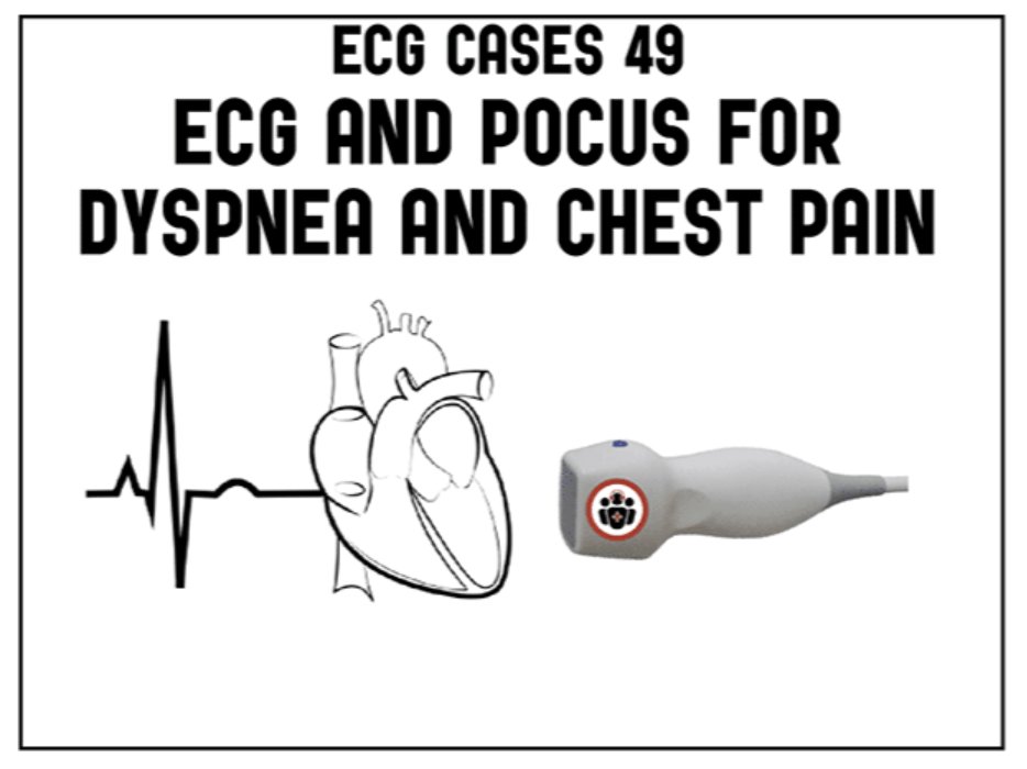 This was exceptionally fun to work on, combining two things we all love - ECGs and #POCUS, how they work together to help you make decisions at the bedside Thanks to @ECGcases for inviting me on for this one! Go follow the blog!