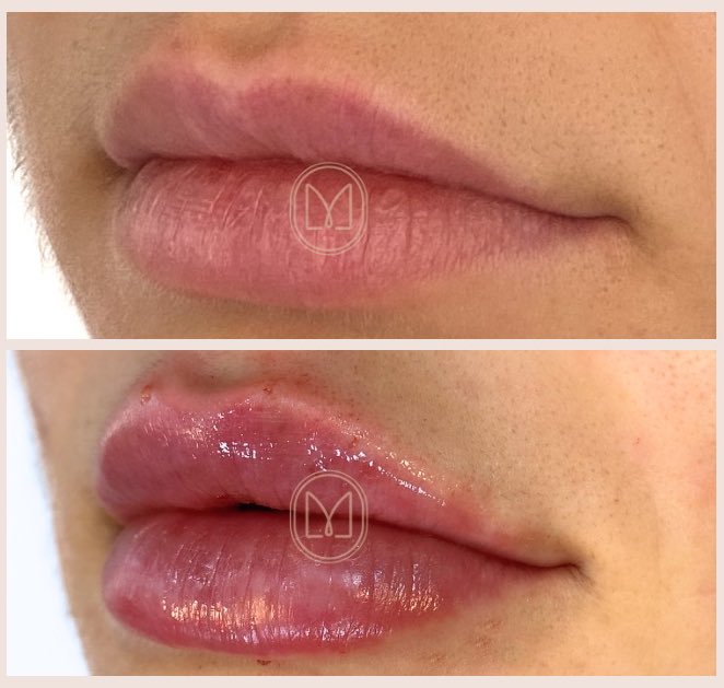 O simples e honesto antes e depois 

Fotografado de forma correta
Procedimento realizado sem exageros 

Fotografia feita com Smartphone!