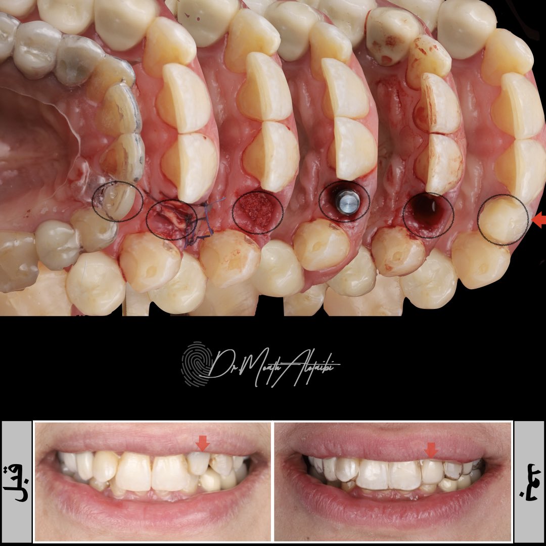 (خلال زيارة واحده) 
تم خلع السن الامامي وعمل الزراعه الفورية والتطعيم العظمي.. 
وخروج المراجع بسن مؤقت 
<<الى ان تتم عملية التئام الزرعه>>

#الزراعه_الفوريه
#زراعة_الأسنان