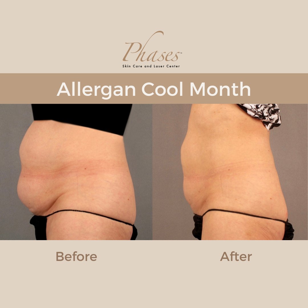 April is Allergan's CoolSculpting® Cool Month! New CoolSculpting patients, rejoice! You'll receive $200 in Allē credit to get started on your journey to eliminate up to 20-25% of treated fat, FDA cleared for 9 areas of the body. This is a limited-time offer, while supplies last.