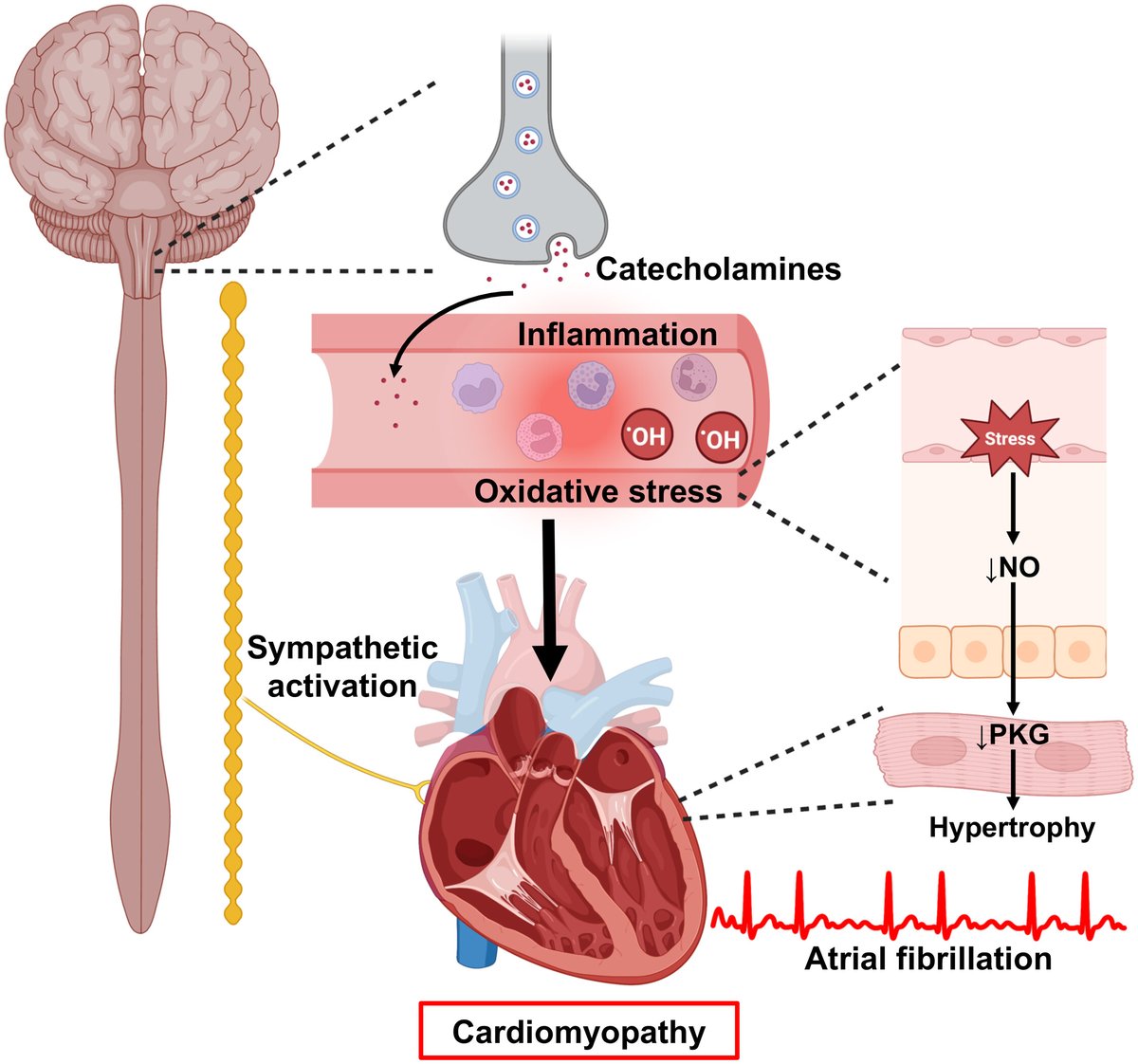 #AFib can impair ventricular function over time in up to 50% of patients.

AF-induced #cardiomyopathy mechanisms include systemic inflammation, oxidative and metabolic stress, cardiomyocyte calcium mishandling, &amp; structural remodeling. bit.ly/3vDUOuC

#JACCHF <a href="/XWehrens/">Xander Wehrens</a>