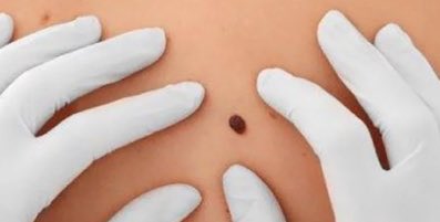 Llegan las vacunas contra el #melanoma 

omniprex.com/llegan-las-vac…