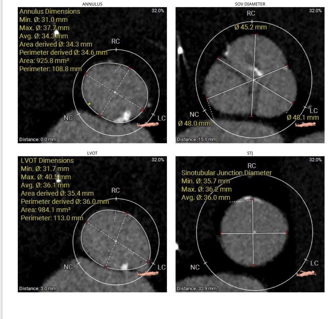 Hussam Suradi (@hsuradi) on Twitter photo #TAVR in extra large AV annulus, poor surgical candidate. Bicuspid with R/L fusion, Diameter 34.3 mm, area 925 mm2, perimeter 108 . LVOT 984mm2. #TAVR with 29 #Sapien 3+ 5cc. Excellent final result with no PVL. <a href="/RushMedical/">Rush University System for Health</a> #TAVR in extra large AV annulus, poor surgical candidate. Bicuspid with R/L fusion, Diameter 34.3 mm, area 925 mm2, perimeter 108 . LVOT 984mm2. #TAVR with 29 #Sapien 3+ 5cc. Excellent final result with no PVL. <a href="/RushMedical/">Rush University System for Health</a>