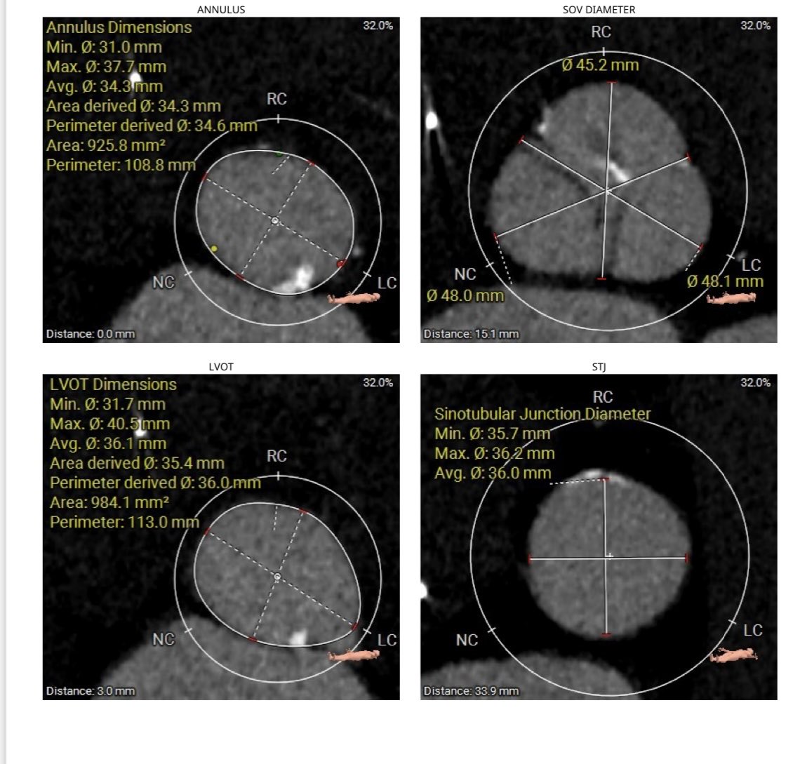 #TAVR in extra large AV annulus, poor surgical candidate. Bicuspid with R/L fusion, Diameter 34.3 mm, area 925 mm2, perimeter 108 . LVOT 984mm2. #TAVR with 29 #Sapien 3+ 5cc. Excellent final result with no PVL. @RushMedical