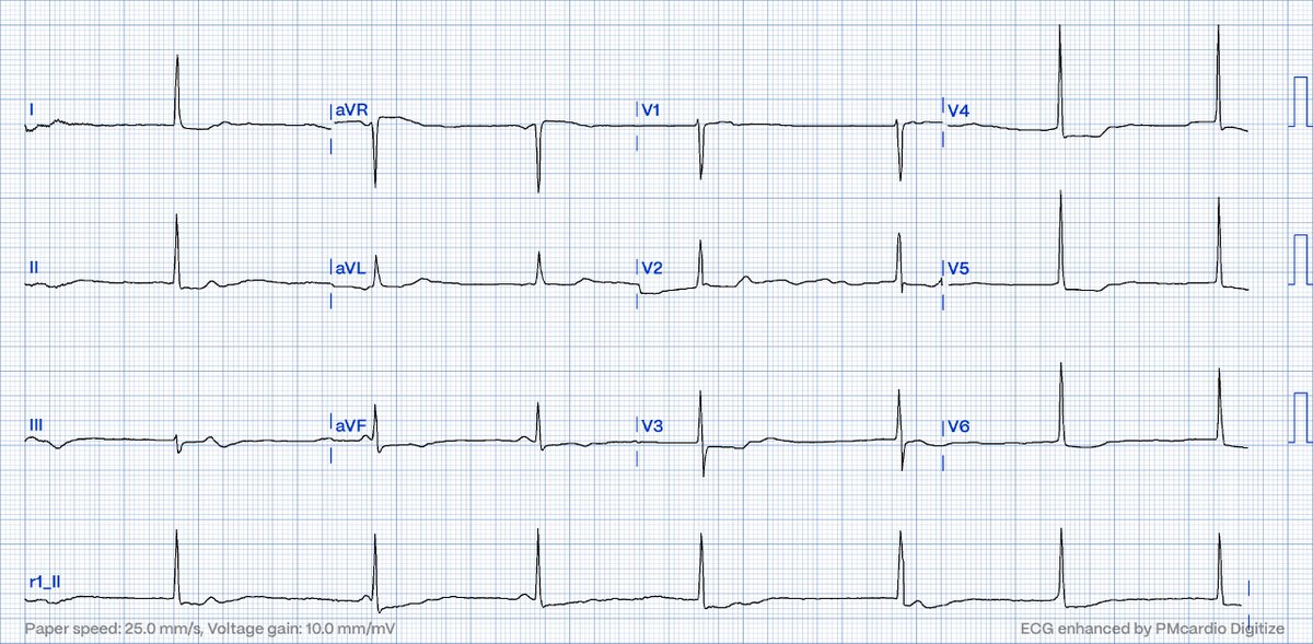 Rhythm? @akneton @yolyabreuh @UlhasDr @DidlakeDW @ecgrhythms @syamkumarmd @IhabFathiSulima @DocNikko @DrPharmDMDTh @Vadeboncoeur_Al @EF_Cardiaca @smithECGBlog @EM_RESUS @iamritu @paomorejon @estudiomedicina @OrlandoRPN @fxgodzeuss #EPeeps #Cardioed #FOAMcc @ResusMed @Sthanu5…