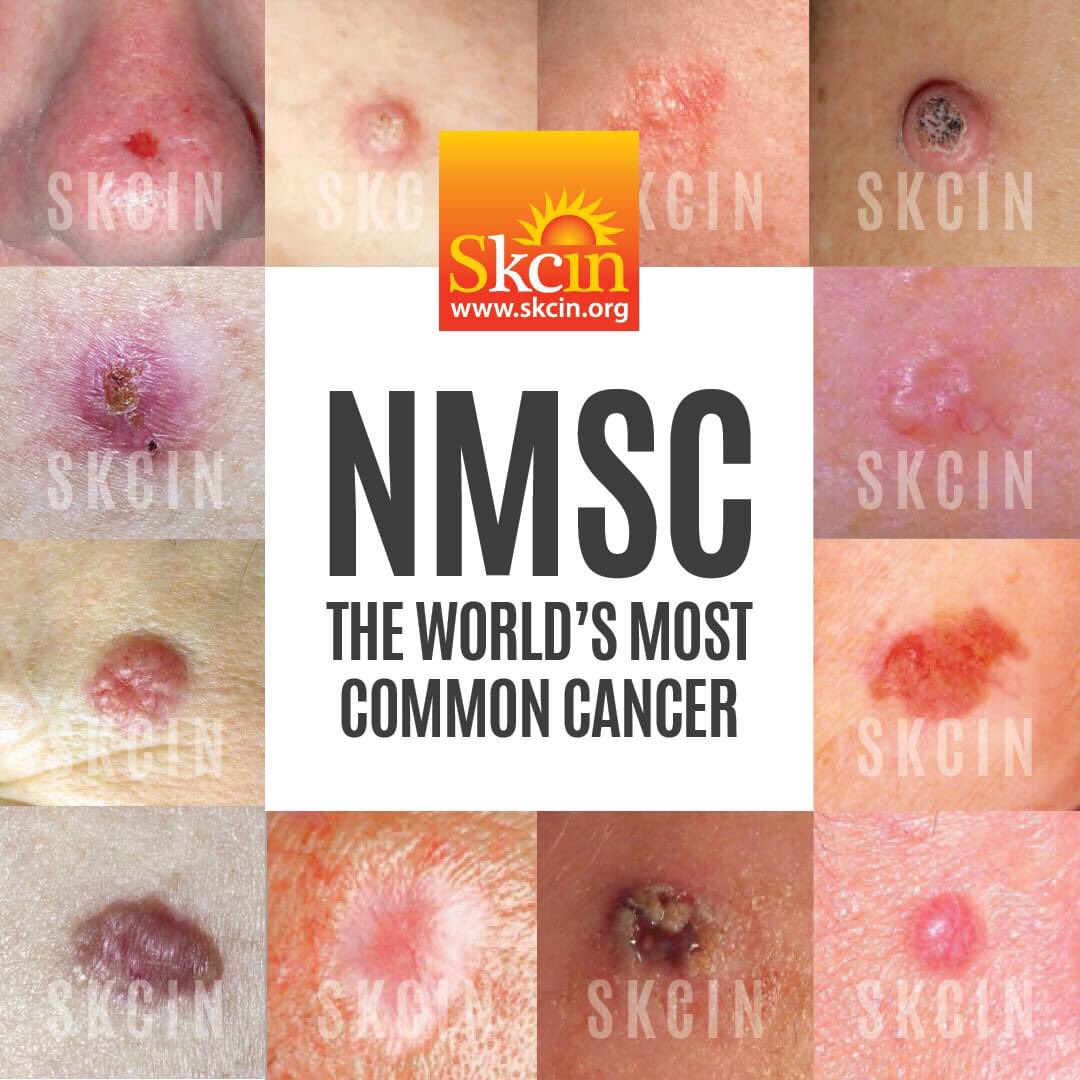 NMSC - Non-melanoma Skin Cancer is globally the most common form of cancer. 1 in 4 men and 1 in 5 women in the UK will be diagnosed with NMSC in their lifetime - and if diagnosed once, you could have many more! Learning how to spot the early signs and symptoms is vital.