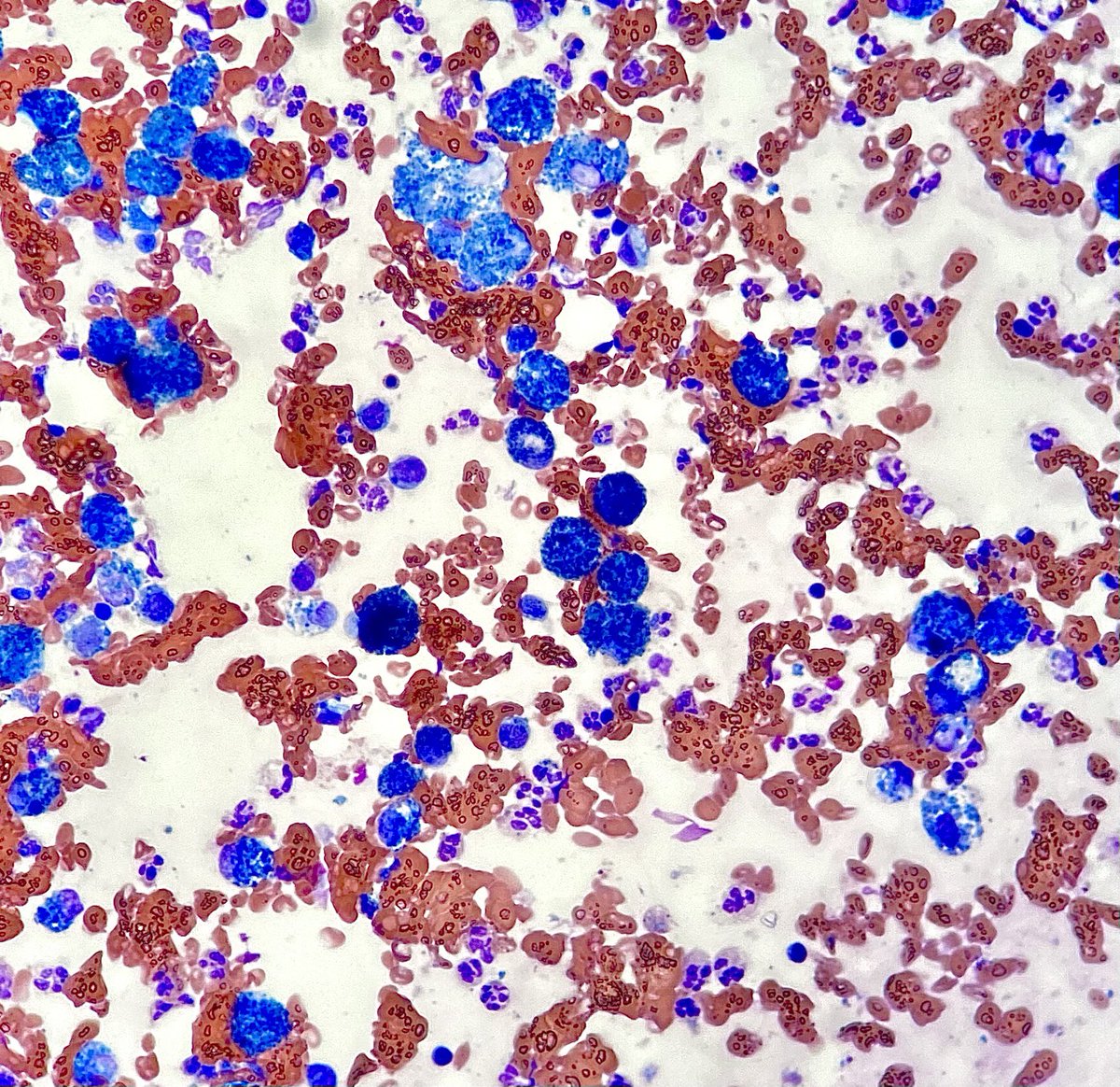 An FNA of an intermittently bleeding Caesarian section scar…benign glands with honeycombing, hemosiderin laden macrophages. Read about it below 👇 #cytopathology #Gynepath #PathTwitter #PathX thanks @RoanWet for the case 💪
