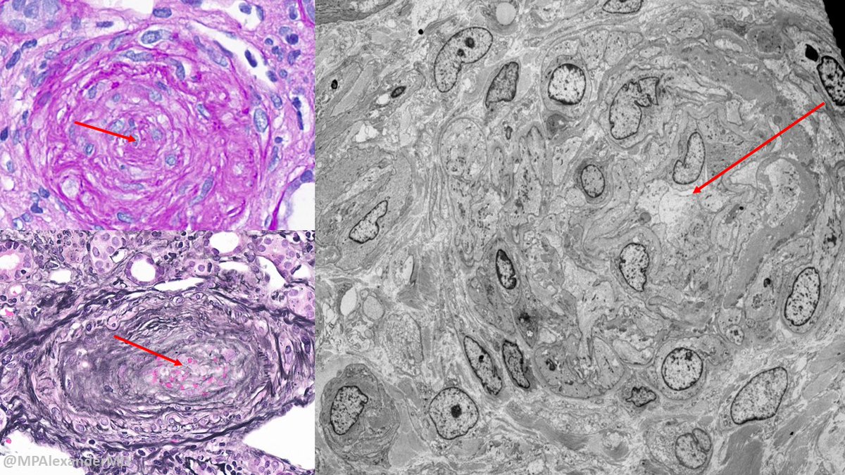 What is 'onion-skin'? Due to the concentric proliferation of smooth muscle cells, the arterioles have an “onion skin” appearance. It is an adaptive response of arterioles to severe (“malignant”) hypertension. The red arrow shows the narrowed lumen. The EM image = wow #PathTwitter