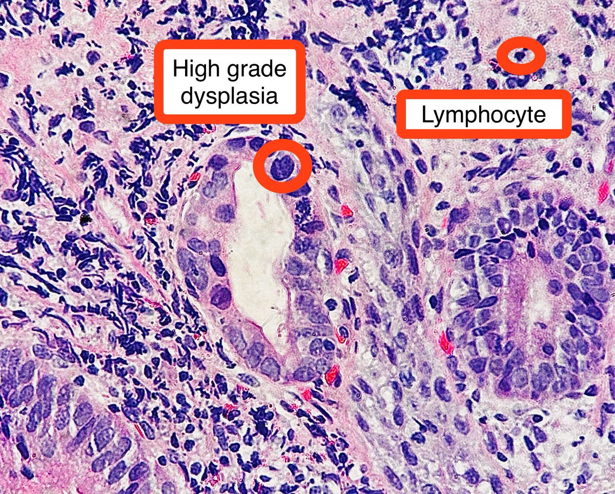 At USCAP 23, I attended a lecture by Dr. Pai @ReetPaiMD1 One of his clues for High grade dysplasia in the esophagus is the nuclei of the dysplastic cell > 3-4x than a lymphocyte I thought of him today 🔬🤓 #pathagonia #path4people #pathx #pathtwitter #gipath #egd #medx