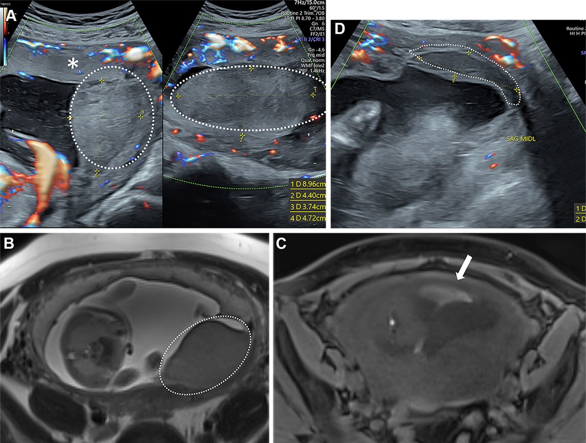 Did you know that severe obstetric hemorrhage is a leading cause of maternal mortality and morbidity worldwide? Common causes of severe antepartum hemorrhage, postpartum hemorrhage, and more are discussed here: bit.ly/3IY7akp @dr_ektam @DrAmitaKamath