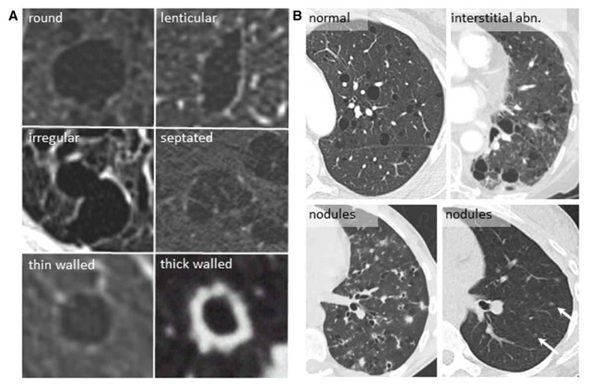 🔥🔥Diagnosis of cystic lung diseases: a position statement from the UK Cystic Lung Disease Rare Disease Collaborative Network ▶️bit.ly/3VHcbVR