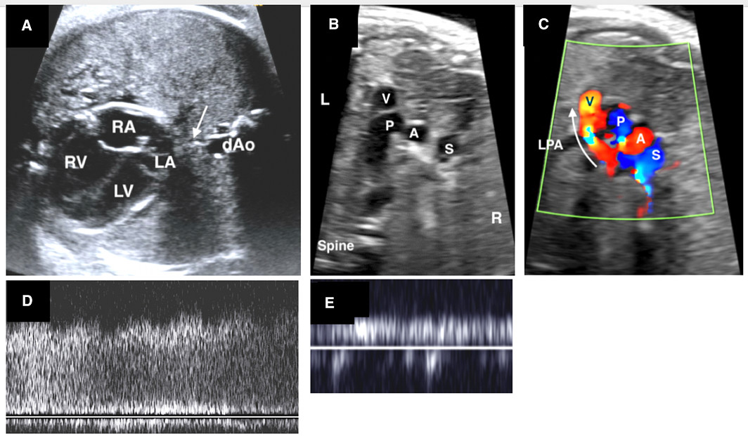 Fetal echocardiography can predict the need for emergent intervention in most with d‐transposition of the great arteries and hypoplastic left heart syndrome. #AHAJournals <a href="/angmcbrien/">Angela McBrien</a> ahajournals.org/doi/10.1161/JA…