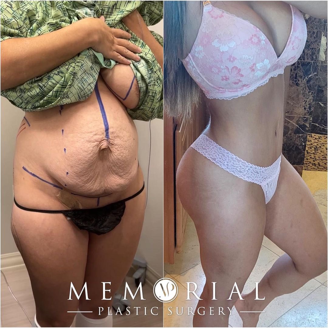 7 months post-op and looking so amazing after her mommy makeover by Dr. Roehl!! 😍🔥🔥

Procedure: #BreastLift w/ Implant Exchange, #TummyTuck, #BBL, #Lipo360, #Lipo to inner thighs 💕
(Pre-Sx: Wt: 120 lbs Ht: 4’11 BMI: 24.23) 

We love seeing pics from our patients 🥰

#newbody