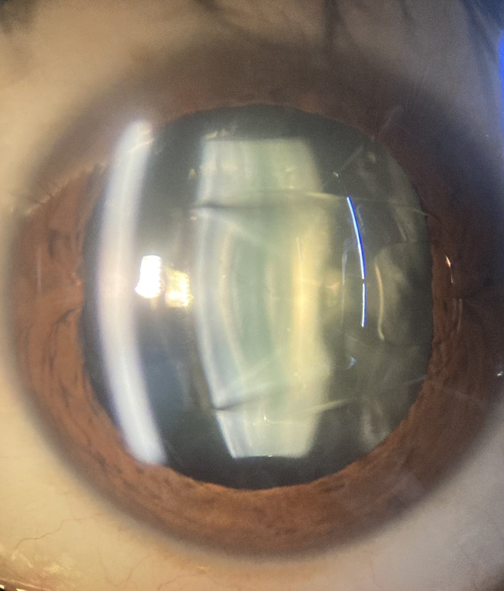 DBerronesM's tweet image. Rayos de convergencia de la luz del Artisan en el cristalino en la segunda imágen. Chulada de óptica 😮‍💨🤌🏽