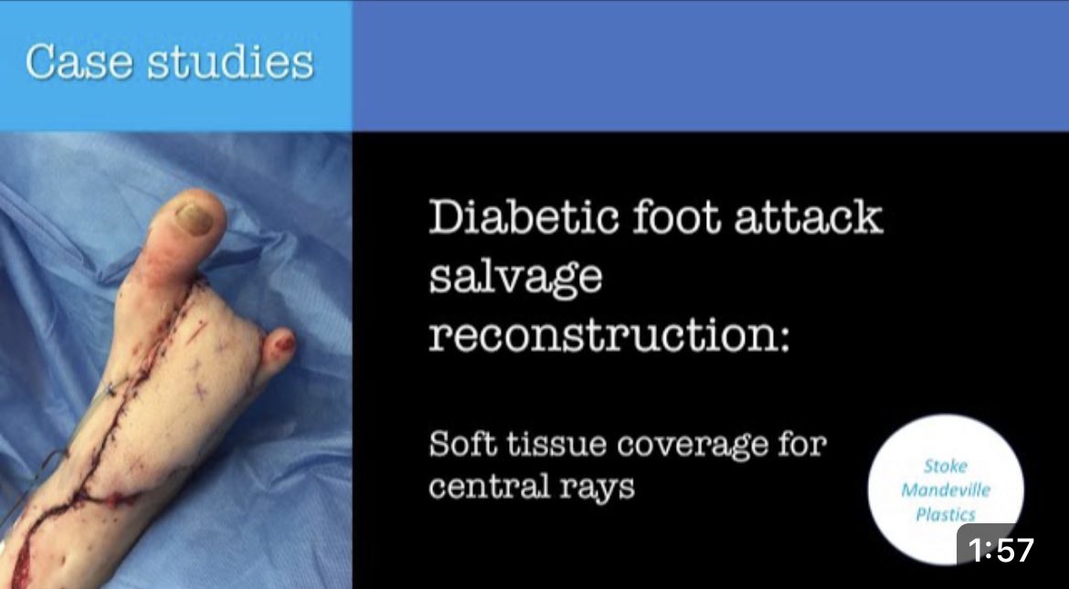 How #plasticsurgery can save 👣 for people with #diabetes foot disease: youtu.be/Tgn3w-r0eCw?si… @BAPRASvoice @BOFAS_UK @DiabetesUK @footindiabetes @EFASnews @ICOPLASTsurgery @VSGBI @RoyColPod @DFSG_org