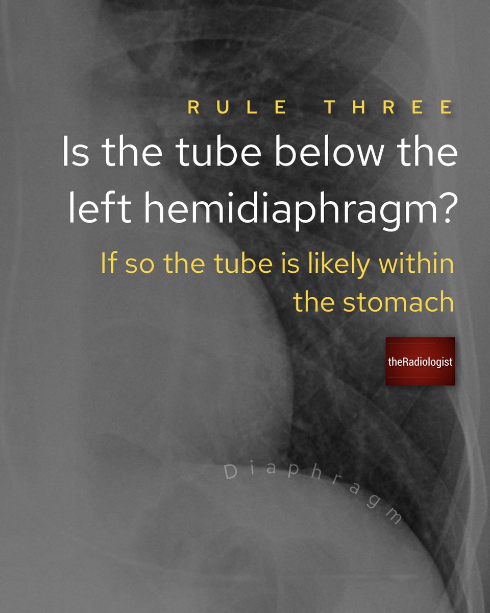 NG tube placement on Chest X-Ray: four rules to follow @radiologistpage #FOAMrad