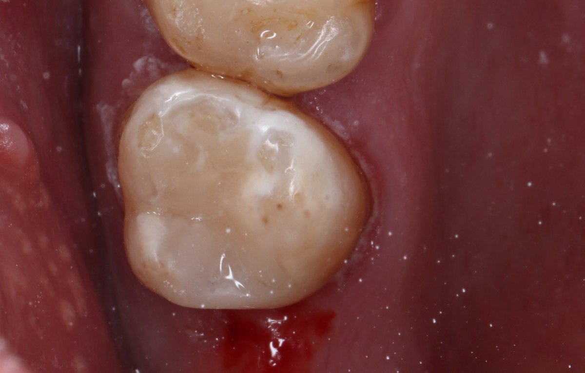 Tooth #17 had caries OD then after removing caries some tips and tricks done for good seal and contour