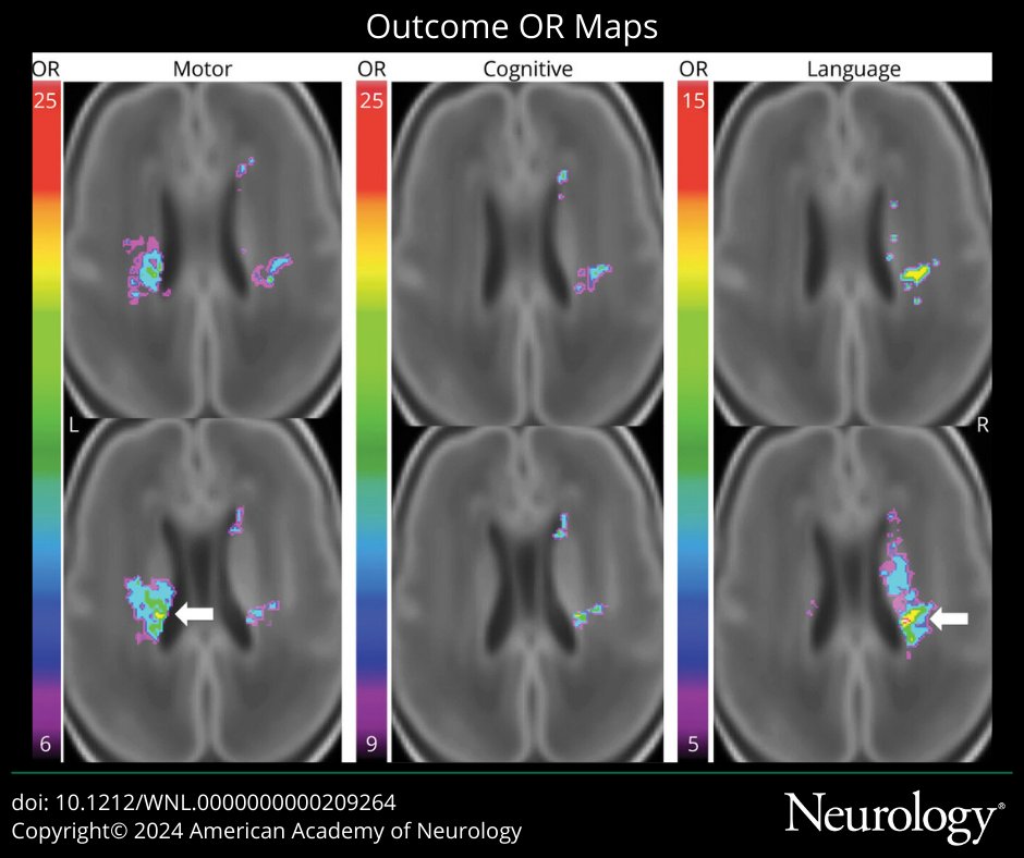 Size and Location of Preterm Brain Injury and Associations With Neurodevelopmental Outcomes: bit.ly/4aIbWON #NeuroTwitter