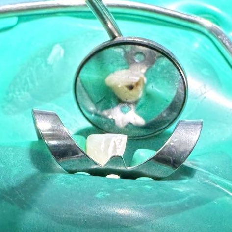 sdentist4's tweet photo. أول حالة اندو 
😮‍💨 https://t.co/hngBESHVaV