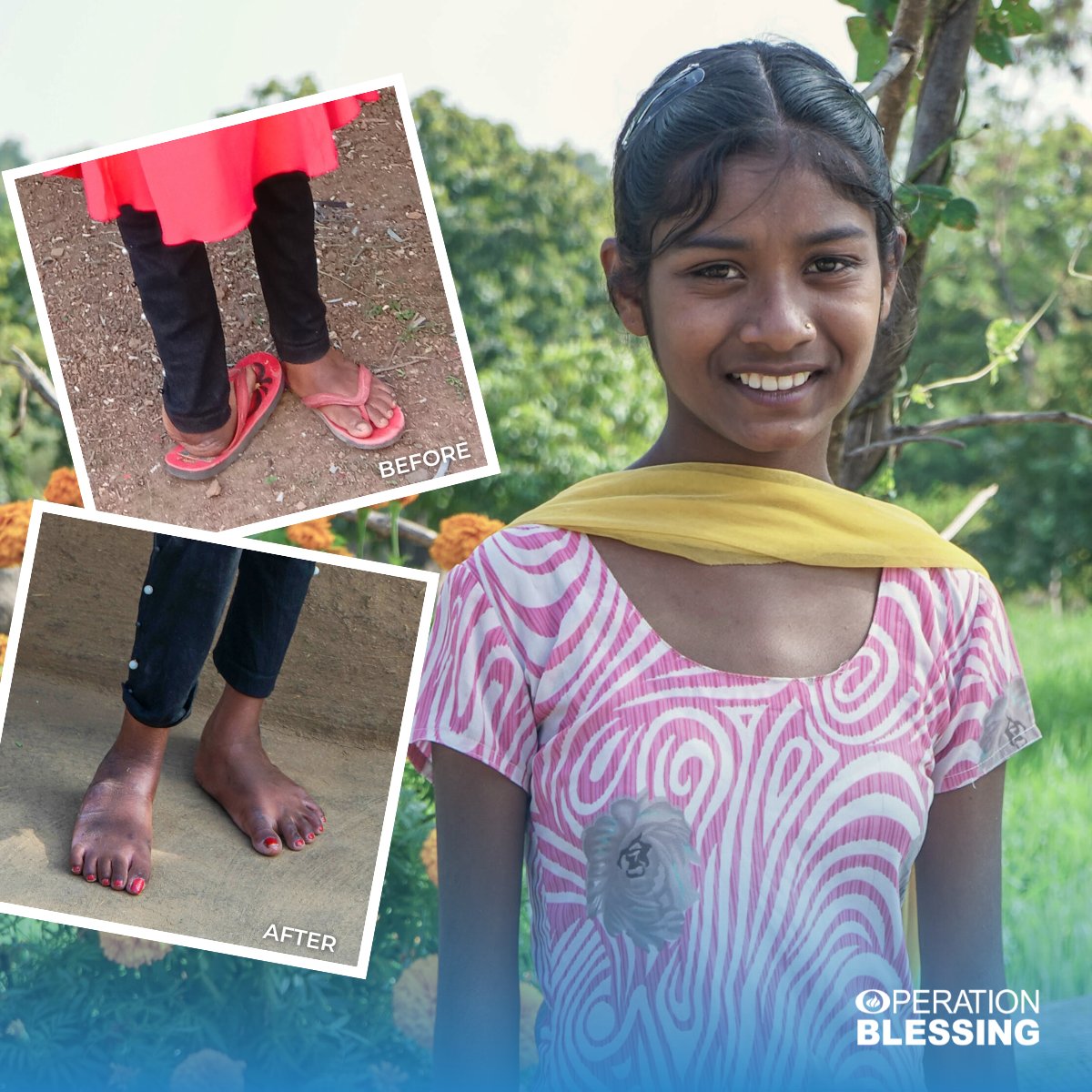 Sonam in India received a #LifeChangingSurgery to repair the severe clubfoot condition she has struggled with since birth! Today, she is 😊 because she is finally able to walk without pain and start pursuing her dream of becoming a #teacher. Thank you!