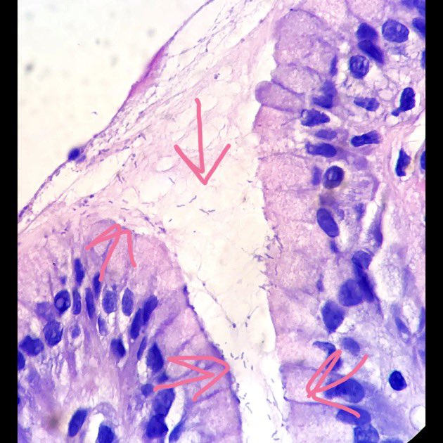 TeamCaptainJohn's tweet photo. Dear literally everyone in medicine,

When we get a stomach bx, we look for H. pylori. Every time. We look, with our eyes. We can see the bugs. Our eyes are the test. Sometimes we use IHC or an awful special stain. But it’s our eyes. Every time. I promise.  #pathology https://t.co/ZfS2HmNL5S
