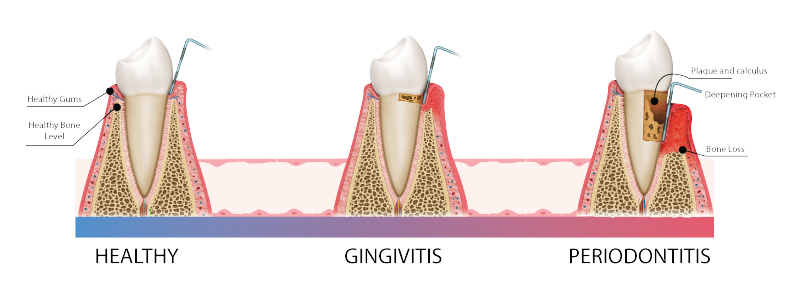 SMLGlobal's tweet photo. THE GATEWAY TO ORAL HEALTH:  PROTECTING THE HEART AT THE SOURCE OF HARM
 those suffering from gum disease are two to three times more susceptible to heart attack, stroke or other serious cardiovascular event.

https://t.co/vl9dLTvnpf https://t.co/p12dUd478O