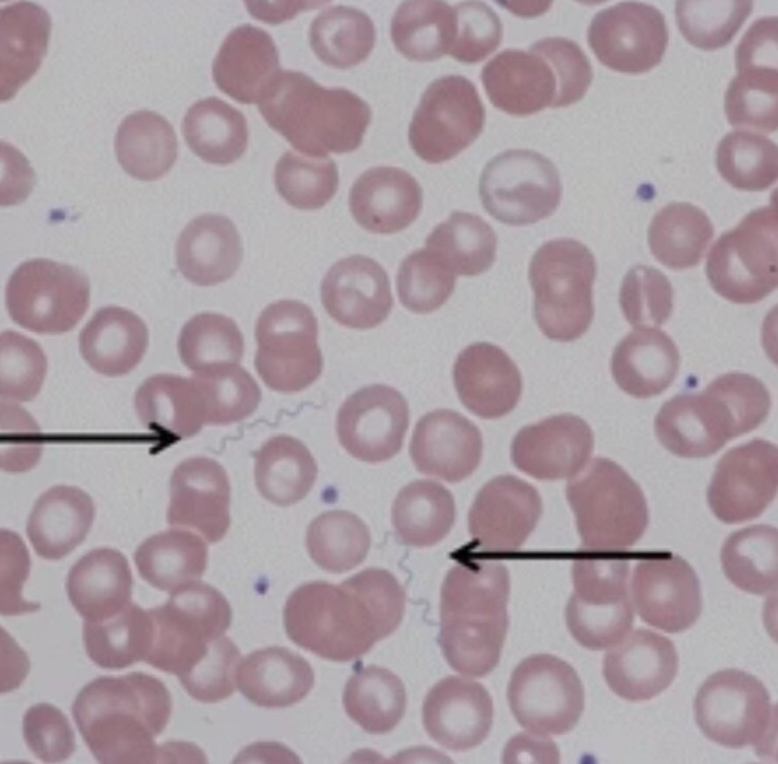 #idboardreview 30 M from Ethiopia in refugee camp x7d now arrived in Europe, has fever x3d f/b chills, dizziness, hepatomegaly, thrombocytopenia, ⬆️inflammatory markers. Blood smear shown. Dx? #medEd #idmedEd #IDtwitter #idxpost