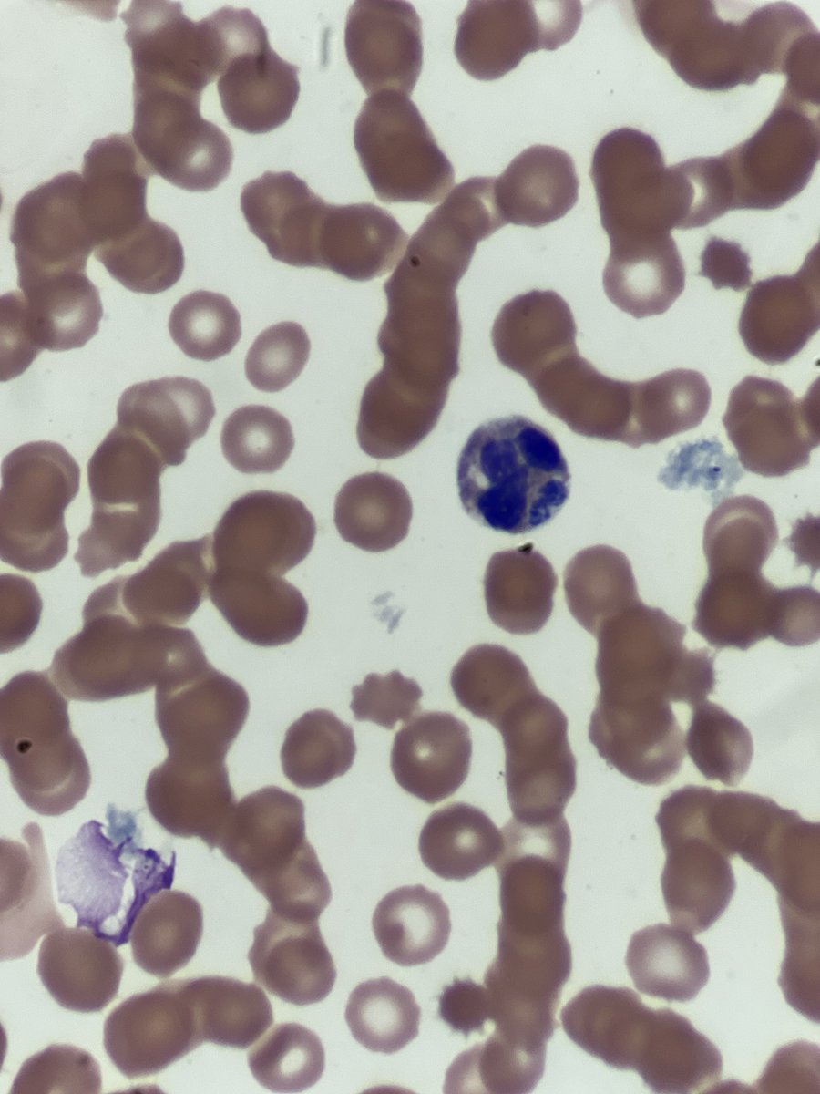 SeanSNiu's tweet photo. Peripheral smear of a 63 yo patient with fever, muscle ache, and found to have a tick attached. What do you see here and what are the main ddx? #pathX #pathpics #pathology #infectiousdisease https://t.co/lhc2vFfinl