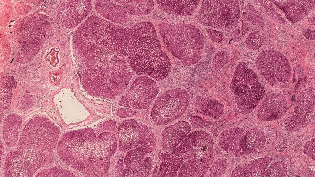 AusSMC's tweet photo. 🧬Inhibiting a gene called Mer tyrosine kinase #MERTK can reduce fibrosis in multiple organs, including the liver, kidneys and lungs, say @WestmeadInst @Sydney_Uni @GarvanInstitute and @UNSW
https://t.co/kjh7JBBAyB https://t.co/T5IexftGhV