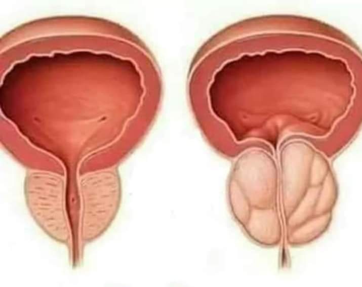 التهاب #المثانة في #المسالك #البولية.
 
1️⃣الوصفة الأولى
1- حبة بصل أحمر
2- حبة ليمون
3- فص ثوم
4- غصنين من أكليل الجبل
5- لتر من الماء النقي
6- حبة طماطم
7- جوز القلب 30 جرام 
8- ملعقة خل تفاح طبيعي
9- ملعقة من زيت الزيتون 
قم بفرم البصل وتقطيع فص الثوم , وقشر الليمونة وليس اللب