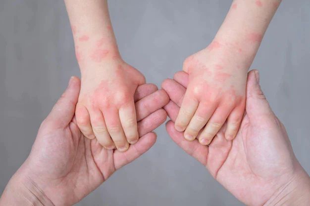 PSA is supporting you to improve appropriate diagnosis and management of eczema, including person-centred use of pharmacological and non-pharmacological agents, common misconceptions, and advice on how to support a written action plan. Join the webinar at buff.ly/3x2eetm
